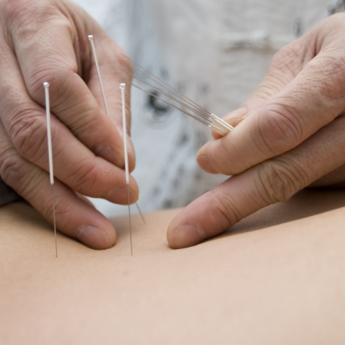 Dry-Needling-Rehab-Partners-Albertville-Centre-AL - 1