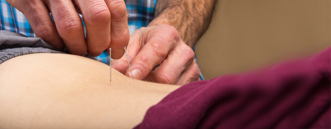 Dry-Needling-Rehab-Partners-Albertville-Centre-AL